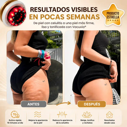 VeloCurve® Masajeador Anticelulitis Inteligente | Piel más lisa en solo minutos al día